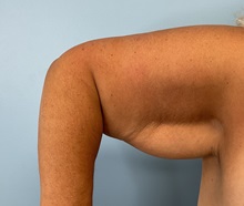 Arm Lift Before Photo by Julia Spears, MD, FACS; ,  - Case 50574