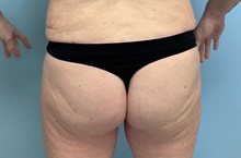 Body Contouring After Photo by Julia Spears, MD, FACS; ,  - Case 50576