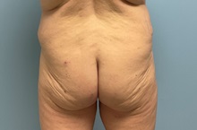 Body Contouring Before Photo by Julia Spears, MD, FACS; ,  - Case 50576