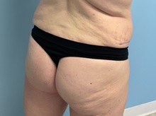 Body Contouring After Photo by Julia Spears, MD, FACS; ,  - Case 50576