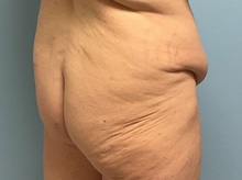 Body Contouring Before Photo by Julia Spears, MD, FACS; ,  - Case 50576