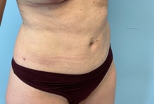Liposuction After Photo by Julia Spears, MD, FACS; ,  - Case 50578