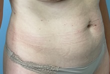 Liposuction Before Photo by Julia Spears, MD, FACS; ,  - Case 50578