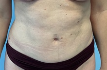 Liposuction After Photo by Julia Spears, MD, FACS; ,  - Case 50578