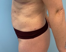 Liposuction After Photo by Julia Spears, MD, FACS; ,  - Case 50578