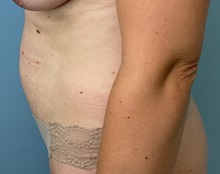 Liposuction Before Photo by Julia Spears, MD, FACS; ,  - Case 50578
