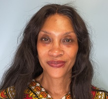 Dermal Fillers After Photo by Julia Spears, MD, FACS; ,  - Case 50604