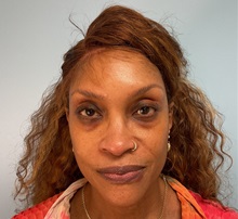 Dermal Fillers Before Photo by Julia Spears, MD, FACS; ,  - Case 50604