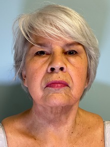 Facelift After Photo by Julia Spears, MD, FACS; ,  - Case 50617
