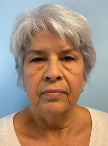 Facelift Before Photo by Julia Spears, MD, FACS; ,  - Case 50617