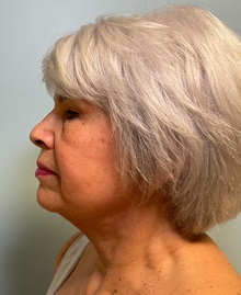 Facelift After Photo by Julia Spears, MD, FACS; ,  - Case 50617
