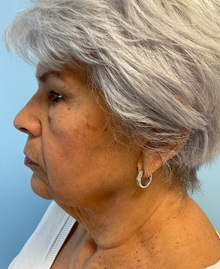 Facelift Before Photo by Julia Spears, MD, FACS; ,  - Case 50617