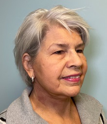 Facelift After Photo by Julia Spears, MD, FACS; ,  - Case 50617