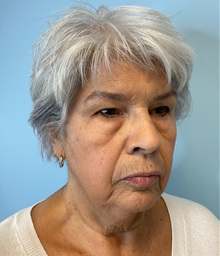 Facelift Before Photo by Julia Spears, MD, FACS; ,  - Case 50617
