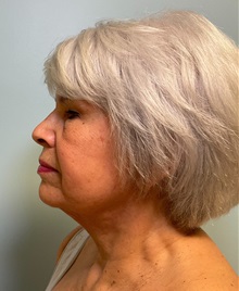 Neck Lift After Photo by Julia Spears, MD, FACS; ,  - Case 50618