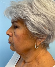 Neck Lift Before Photo by Julia Spears, MD, FACS; ,  - Case 50618