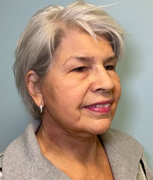 Neck Lift After Photo by Julia Spears, MD, FACS; ,  - Case 50618