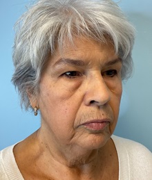 Neck Lift Before Photo by Julia Spears, MD, FACS; ,  - Case 50618