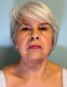 Neck Lift After Photo by Julia Spears, MD, FACS; ,  - Case 50618