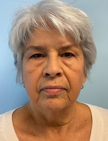 Neck Lift Before Photo by Julia Spears, MD, FACS; ,  - Case 50618