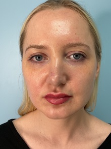 Dermal Fillers After Photo by Julia Spears, MD, FACS; ,  - Case 50631