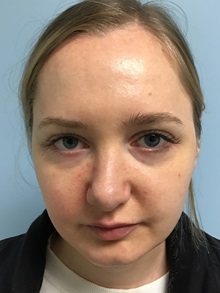 Dermal Fillers Before Photo by Julia Spears, MD, FACS; ,  - Case 50631