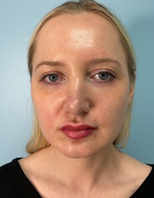 Botulinum Toxin After Photo by Julia Spears, MD, FACS; ,  - Case 50632