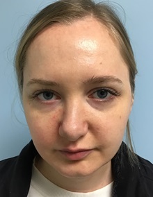Botulinum Toxin Before Photo by Julia Spears, MD, FACS; ,  - Case 50632