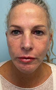 Facelift After Photo by Julia Spears, MD, FACS; ,  - Case 50647