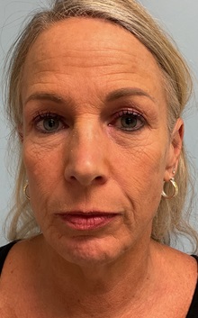 Facelift Before Photo by Julia Spears, MD, FACS; ,  - Case 50647