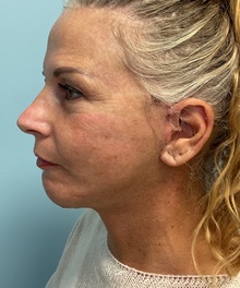 Facelift After Photo by Julia Spears, MD, FACS; ,  - Case 50647