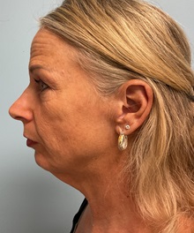 Facelift Before Photo by Julia Spears, MD, FACS; ,  - Case 50647