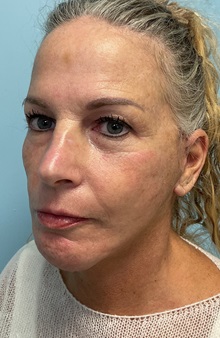 Facelift After Photo by Julia Spears, MD, FACS; ,  - Case 50647