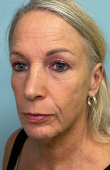 Facelift Before Photo by Julia Spears, MD, FACS; ,  - Case 50647