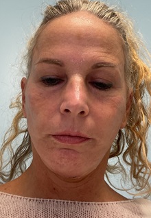 Facelift After Photo by Julia Spears, MD, FACS; ,  - Case 50647