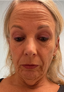 Facelift Before Photo by Julia Spears, MD, FACS; ,  - Case 50647