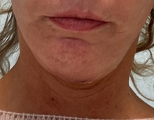 Chin Augmentation After Photo by Julia Spears, MD, FACS; ,  - Case 50646
