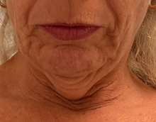 Chin Augmentation Before Photo by Julia Spears, MD, FACS; ,  - Case 50646