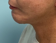 Chin Augmentation After Photo by Julia Spears, MD, FACS; ,  - Case 50646