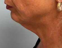 Chin Augmentation Before Photo by Julia Spears, MD, FACS; ,  - Case 50646