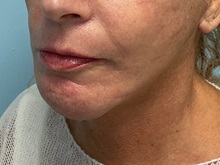 Neck Lift After Photo by Julia Spears, MD, FACS; ,  - Case 50645