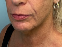 Neck Lift Before Photo by Julia Spears, MD, FACS; ,  - Case 50645