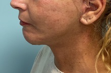 Neck Lift After Photo by Julia Spears, MD, FACS; ,  - Case 50645