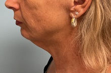 Neck Lift Before Photo by Julia Spears, MD, FACS; ,  - Case 50645