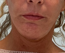 Neck Lift After Photo by Julia Spears, MD, FACS; ,  - Case 50645