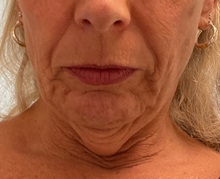 Neck Lift Before Photo by Julia Spears, MD, FACS; ,  - Case 50645