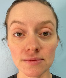 Botulinum Toxin After Photo by Julia Spears, MD, FACS; ,  - Case 50648