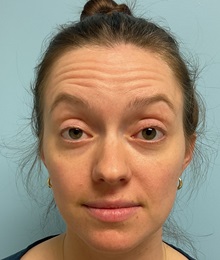 Botulinum Toxin Before Photo by Julia Spears, MD, FACS; ,  - Case 50648