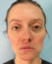 Botulinum Toxin After Photo by Julia Spears, MD, FACS; ,  - Case 50648