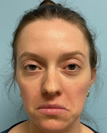 Botulinum Toxin Before Photo by Julia Spears, MD, FACS; ,  - Case 50648